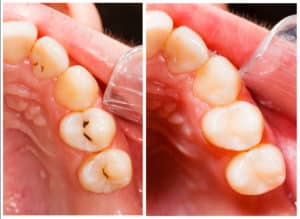 before&after - toothcolored filling