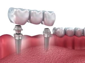 implant bridge