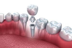 implant crown and adjacent teeth
