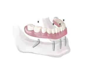 mandibular implant denture
