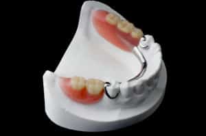 removable partial denture