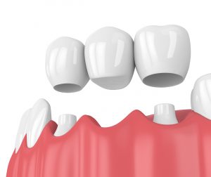 placing a dental bridge