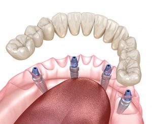 all-on-4 implant dentures