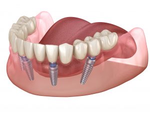 all-on-4 implant dentures