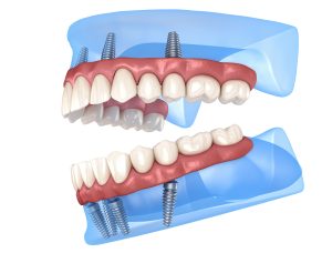 allen implant dentures