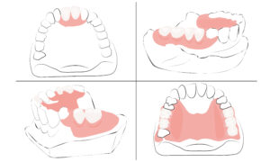 allen partial dentures