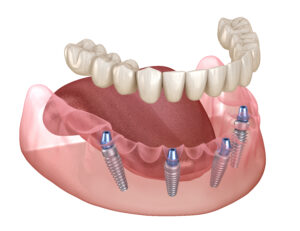 allen all on four dentures