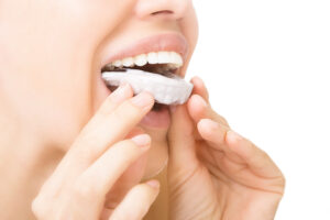 allen teeth whitening